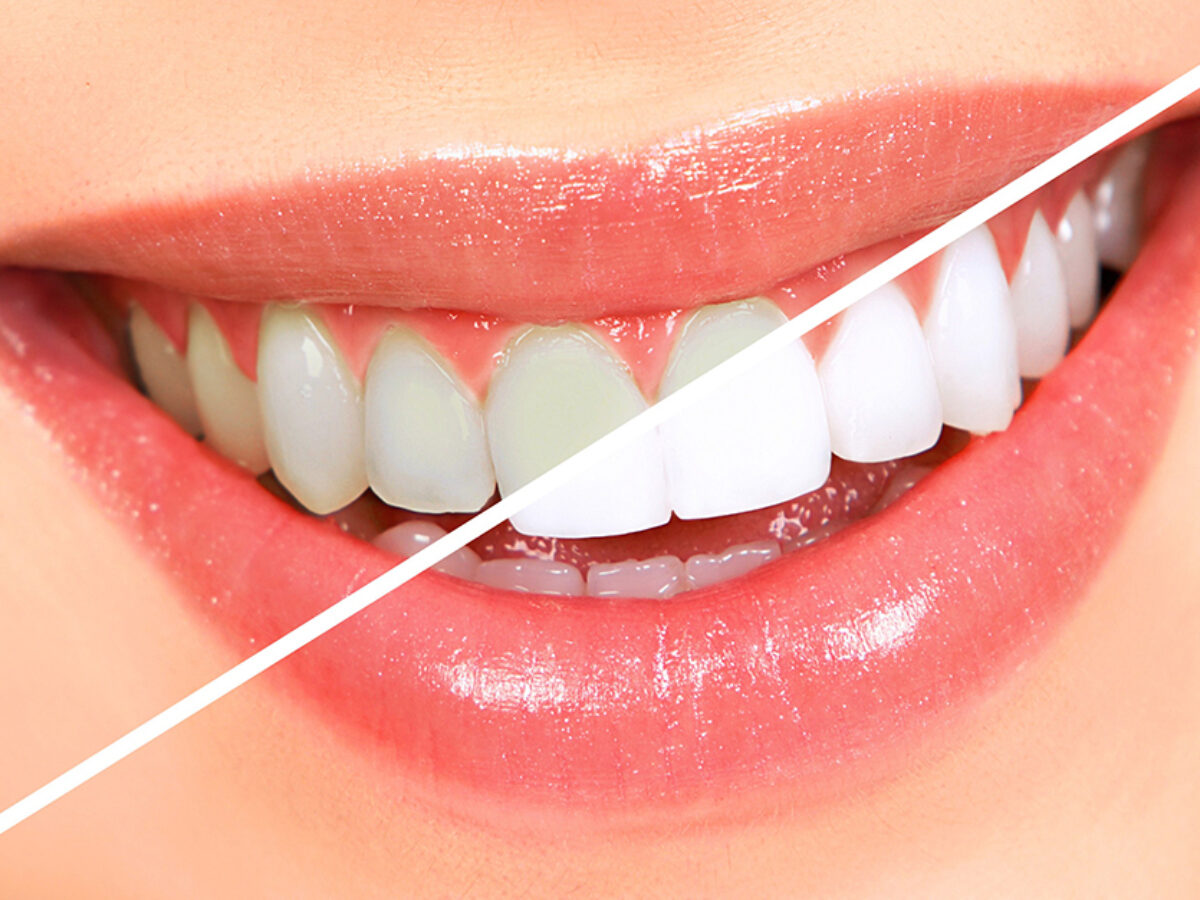 Teeth Whitening Services In Dubai